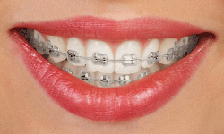 metal braces